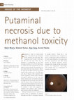 Research paper thumbnail of Putaminal necrosis due to methanol toxicity