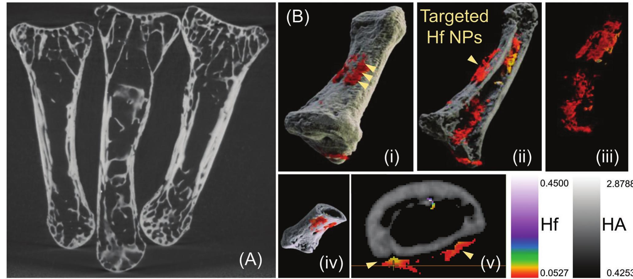 Figure 7. A) u-CT images of the bone. 1: control clean; 2: soaked in targeted Hf NPs; 3: soaked in nontargeted Hf NPs; B) ex vivo human bon microdamage and the distribution of targeted nanoparticles as inspected by spectral CT. Hafnium (red) in the sample is differentiated from bon (hydroxyapatite; white/gray). The arrows point to the damage site.  In one cohort of animal (targeted nanoparticle-injected), the muscle tissues from the surgical site were dissected following euthanization and was processed for TEM. In Figure 8C, gen- eral features of the skeletal muscle are shown, specifically the sarcomere, I band, Z band, A band, and mitochondrion are labeled. Of note is the presence of sub-5 nm targeted nanoparticles in the sarcoplasmic reticulum even after being exposed to the biological fluids, without noticeable aggregation, confirming the biologic stability.   to dehydration using ethanol followed by a surgery in the left hind limb. Using a surgical scalpel, a small linear microcrack (1-2 cm long x 0.2 cm deep) was induced in the hind limb. In contrast the right hind limbs were left intact and used as comparison. The surgical site was sutured, and the animals were intramuscularly administered with the nanoparticles. In addition, the animals with only surgically operated limb without injection was considered as another control. Targeted and nontargeted probes (100 UL) were immediately injected into the muscle surrounding the left tibia and were monitored at various time points, ie., 30 min and 5 h and imaged on a GE 16 Slice CT machine (80 kVp). As shown in Figure 8A,B, for the animals injected with the targeted nanoparticles, the dense accumulation of nanoparticles was seen adjacent to the bone at 
