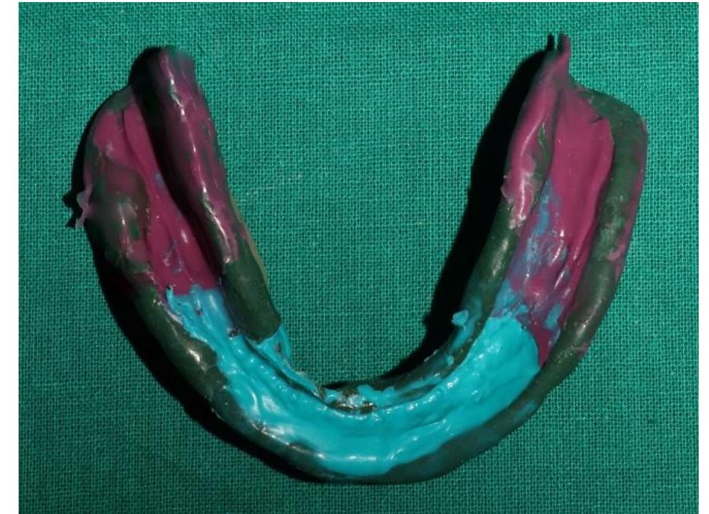 Fig 4: Final mandibular impression 