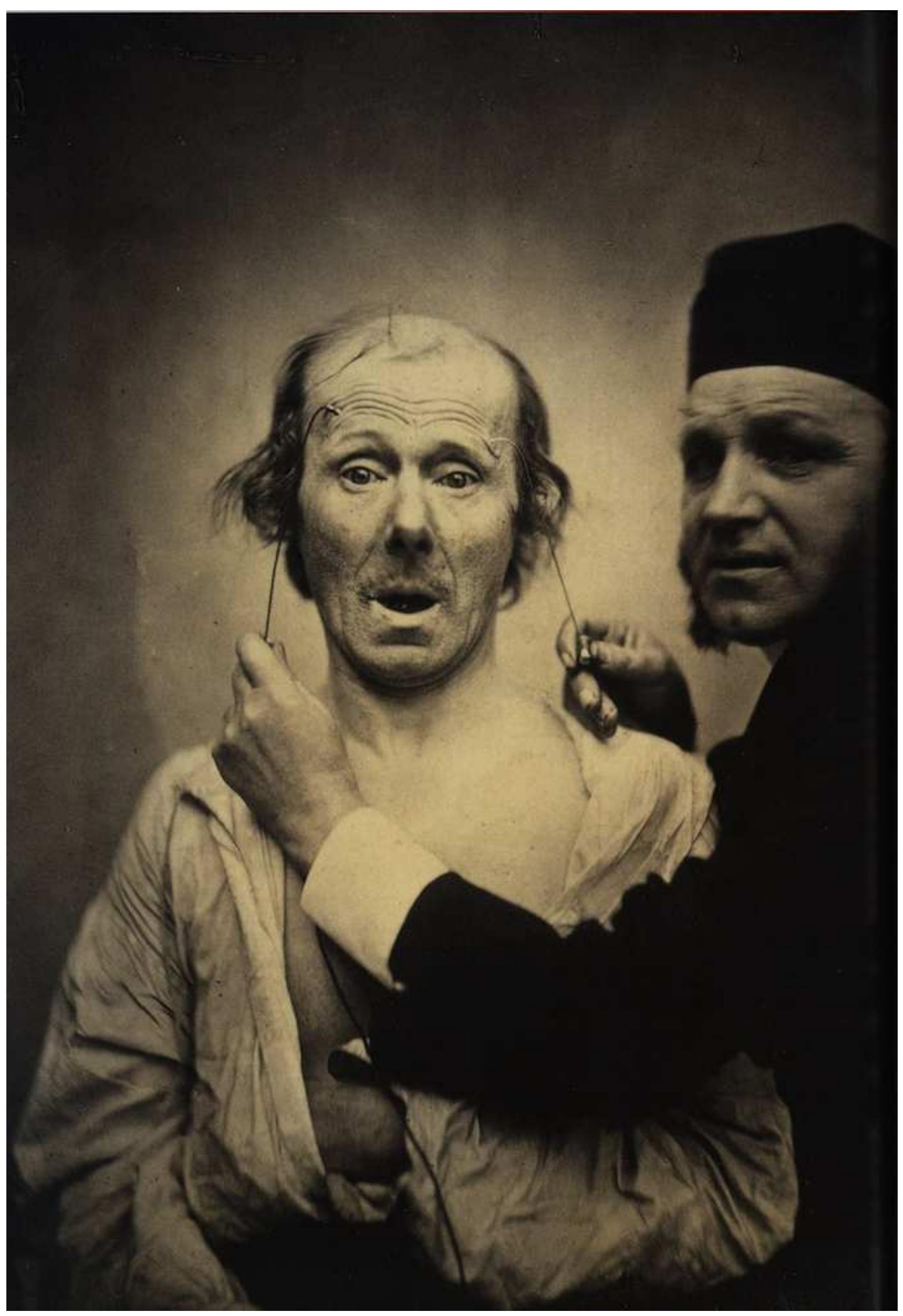 Fig 2. “Facial Electrostimulus Experiments” (from “Mécanisme de la physionomie humaine’), Guillaume Duchenne de Boulogne, ca. 1862 
