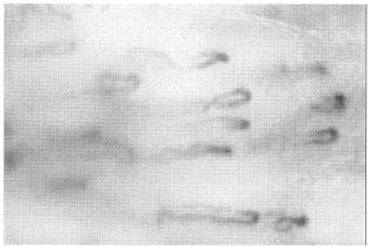 Fig. 1. Nailfold capillaroscopy image showing typical distortions found in a patient.