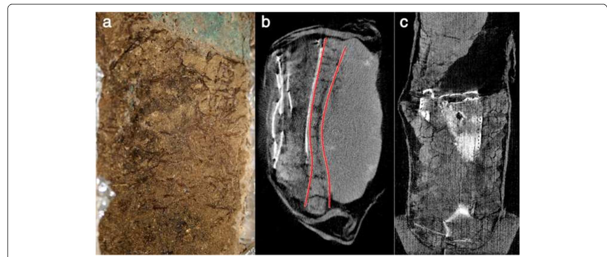 Figure 6 CT horizontal and lateral sections. (a) picture of a detail during the micro-excavation; CT horizontal (b) and lateral (c) sections showing porous and cracked layers around the artefact.  of the deceased's vertebrae (later found during the micro- excavation) that broke the metal belt and contributed to the distortion and the fragmentation of the belt itself. Moreover, CT images suggests the presence of two add- itional porous and cracked layers around the artefact, unidentifiable but clearly different from the homoge- neous and compact layer made by sand-like burial soil (Figure 6). During the micro-excavation it was established that one of them is a large piece of leather, completely degraded and disintegrated, and another one is an organic layer, related to the base level of the grave. Both organic layers were taken using gauze fixed with acrylic resin. It is worth to note that the leather layer has been recovered  Furthermore the CT reconstruction allowed to detect other materials, even if less clearly than metals: for example, in Figure 5, a CT horizontal section shows one 
