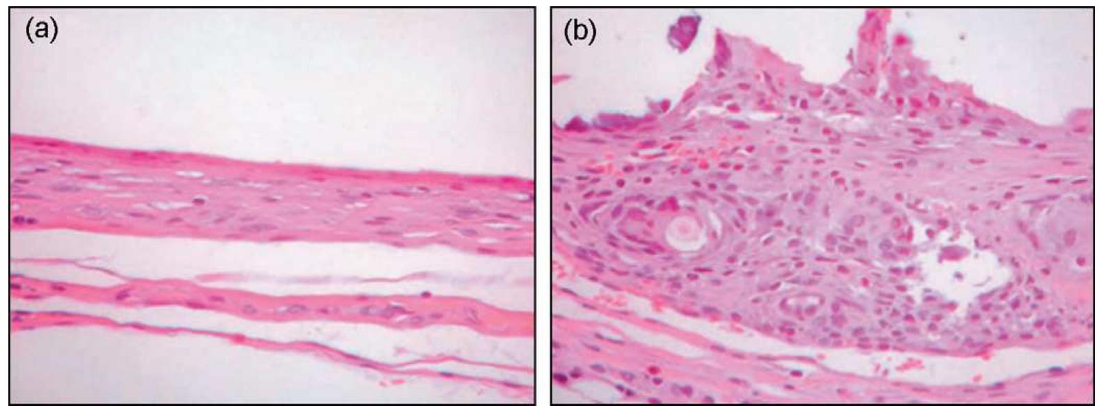 Fig. 14. Histology of capsules surrounding the (a) uncoated and (b) bioglass coated, catherter segments. (Reprinted from [75] with permissions from Nature Publishin Group.)  Polymers are long chain molecules consisting of large number of small repeating units known as monomers. They belong to the family of macromolecules and represent the largest class of biomaterials. Polymers can be derived either from natural sources or from synthetic organic sources. The different types of polymers  10CaCO3 + 6(NH4)2 +2H20 — Ca10(PO4)6(OH)2 + 6(NH4)2CO3 + 4H,CO3 
