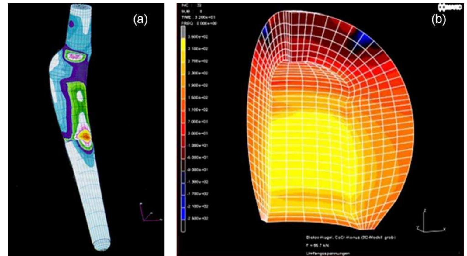 Fig. 25. A three-dimensional finite element model for the stress distribution under in vivo conditions across (a) a metallic hip endoprosthesis, and (b) a ceramic ball, used ina hip implant. (Reprinted from [119] with permission from source: http://www.endolab.de/computer/computersimulation_e.htm.)  -onditions, cold working, annealing cycles, etc. A summary of the ‘epresentative mechanical properties of three implant grade netallic materials based on its processing conditions is listed in fable 5 [15]. Unfortunately, all of these values are obtained from standard samples with simple and regular geometries and may not ‘epresent the actual stress or loading conditions occurring on a ‘omplex shaped implant under in vivo conditions. Hence, a ‘omputational-based finite element analysis (FEA) is mostly ollowed to solve this problem [15,115-119]. Using a finite  element approach the distribution of stresses at various locations of a complex shape implant under in vivo conditions can be easily calculated. Fig. 25 shows the stress distribution across a ceramic head and a hip stem used for hip implant prosthesis obtained by FEA technique [119]. Apart from its use for proper design of a prosthetic device, FEA may also be used to evaluate the stresses occurring across the surrounding tissues upon the insertion of an implant material and thereby its effect on tissue growth, remodeling and degeneration [118]. 