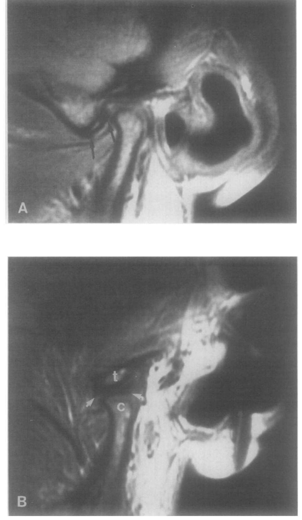 FIGURE 2. A, MRI of the right TMJ in the sagittal plane and with the jaw closed shows an anterior disc (arrows). B, Open jaw position shows the disc (arrows) to have reduced into a norma! relationship between the condyle (c) and temporal bone (t). This patient had no signs or symptoms of internal derangement related to disc displace- ment.