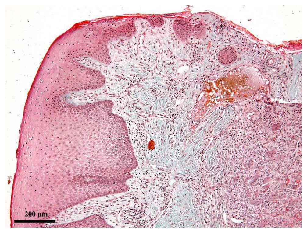 Fig.2. Hemosiderin deposition could be seen in the areas of old hemorrhage. Goldner’s trichrome.  Numerous authors stated that MGCs result by the coalescence and fusion of the epithelioid cells (Cotran et al., 1989, McNally et al, 2011). In order to sustain this idea, on the histological sections, we also noted that the epithelioid cells showed a marked tendency to fuse with each other; the 