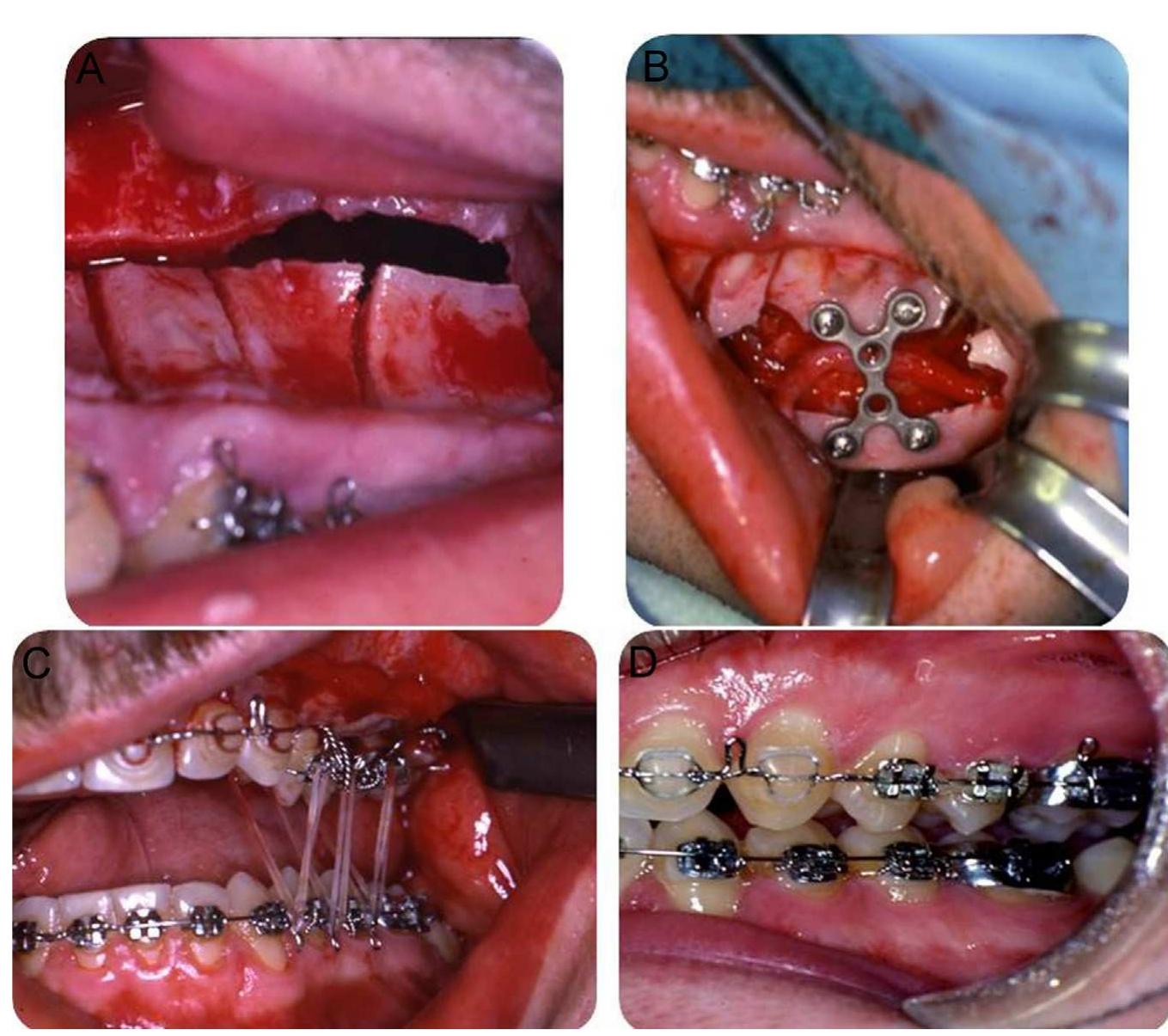 Figure 6. Example of adult male patient affected with PFE. Treatment included segmental osteotomy in the maxillary arch (A and B) with immediate elastic traction (C and D). 