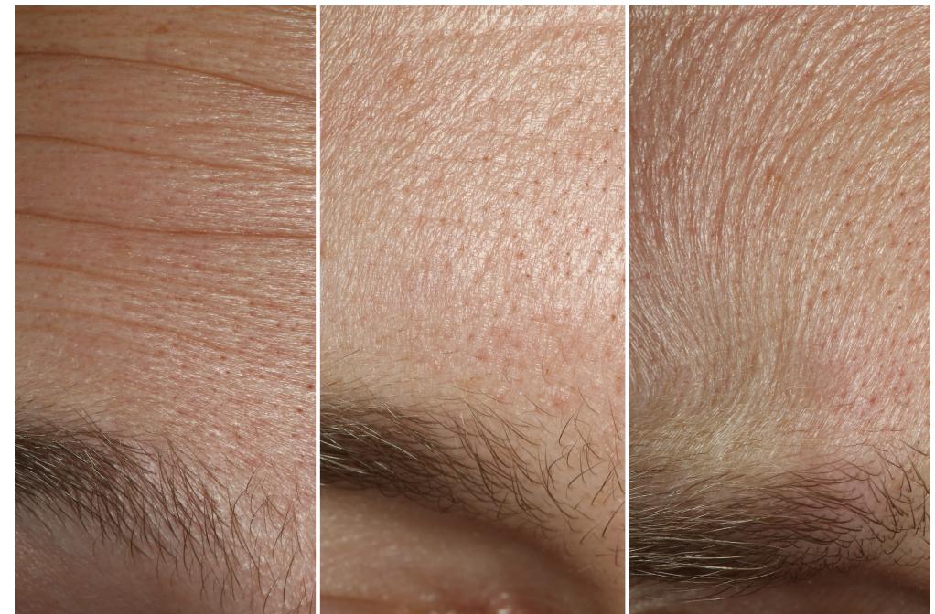 Recently, [Graham et al. 2013] recorded skin microstructure at a level of detail below a tenth of a millimeter for sets of skin patches on a face, and showed that texture synthesis could be used to increase the resolution of a mesostructure-resolution facial scan to one with microstructure everywhere. They demonstrated that skin microstructure makes a significant difference in the appear- ance of skin, as it gives rise to a face’s characteristic pattern of spatially-varying surface roughness. However, they recorded skin microstructure only for static patches from neutral facial expres- sions, and did not record the dynamics of skin microstructure as skin stretches and compresses.  Figure 2: Three real forehead expressions (surprised, neutral, and perplexed) made by the same subject showing anisotropic deforma- tions in microstructure. 