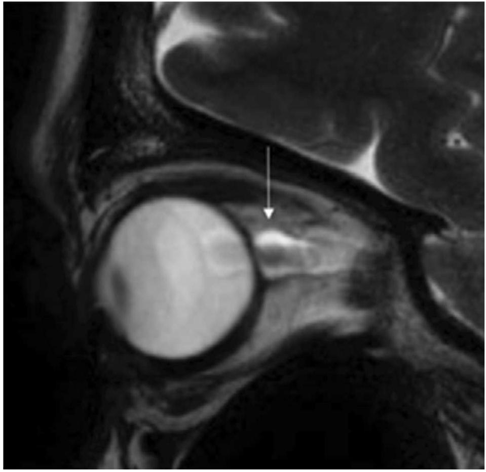 Figure 2 Dilated optic nerve of a patient with visual field defects and unexplained widespread pain.  mandibular disorders, and masticatory pain. The sensory 