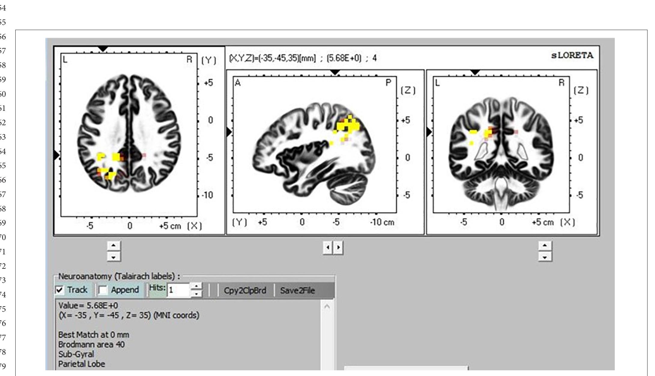 FIGURE 9 | Transcendental Meditation during sitting (yellow) vs. simMRI.  FIGURE 8 | Transcendental Meditation during sitting (yellow) vs. supine. 