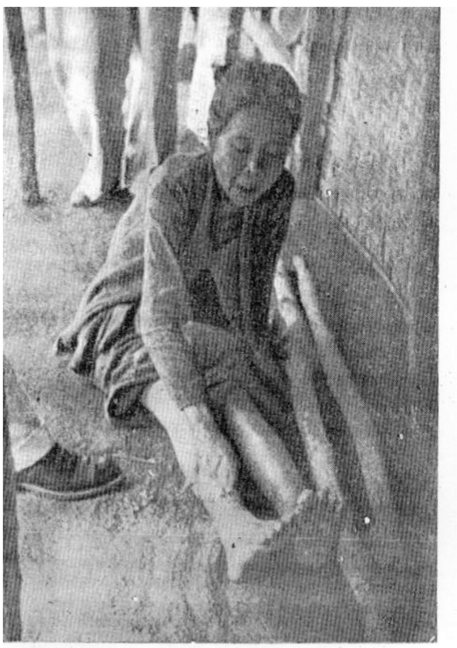 Above: A Hunger Oedema Patient in Gunung Kidul (1953).