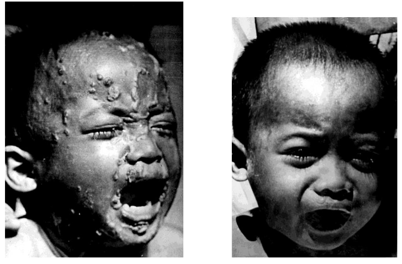 Yaws, Before and After Treatment: Penicillin a Magic Bullet The photograph on the left depicts a yaws-afflicted infant who is treated with penicillin. The results of the cure are